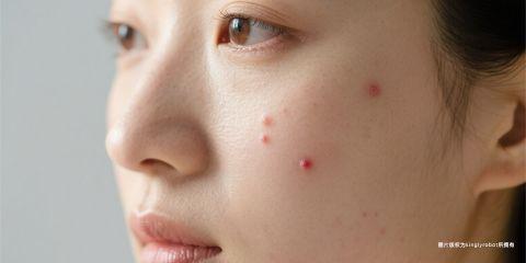 皮肤状态不仅取决于外用保养，还与日常饮食息息相关。越来越多研究显示，饮食结构会直接影响 皮脂腺分泌与皮肤油水平衡。某些食物可能刺激油脂分泌过度，使脸部更容易出油，甚至导致粉刺与痘痘。了解这些食物并适度控制，有助于维持肤质稳定。