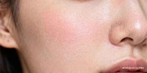 在皮肤学中，「敏感肌肤」（Sensitive Skin）并不是一种疾病，而是一种常见的皮肤状态。此类肌肤对外界环境与产品成分的耐受力较低，容易出现不适反应。根据临床观察与专业研究，敏感肌肤具有一些典型征兆，透过辨识这些特征，人们能更清楚自己的肤质属性，进而选择正确的护理方式。以下整理敏感肌的五大征兆，供读者检视自身情况。