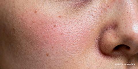 敏感肌肤是一种常见的皮肤状态，特点在于皮肤屏障功能较弱、对外界刺激耐受性不足，因而更容易受到环境与生活习惯影响。其中，「换季」、「熬夜」以及「压力」是最常见的三大诱因。了解这些因素如何影响肌肤，有助于预防敏感加剧，并调整护理策略。