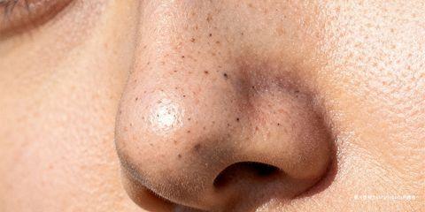 黑头粉刺（Blackheads），又称「开放性粉刺」，是常见的皮肤问题，特别容易出现在鼻翼、额头与下巴等油脂分泌旺盛的部位。虽然黑头不如囊肿性痘痘严重，但它往往影响肤质细致度与外观，甚至在未妥善处理下可能演变为更严重的痤疮。本文将从皮肤学角度解析黑头的形成机制与成因。