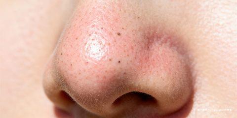 「草莓鼻」是许多人对鼻头黑头粉刺的俗称，因毛孔中黑点密布而与草莓表面相似。虽然不会直接危害健康，但对外观造成困扰，甚至影响自信心。要有效改善草莓鼻，必须先理解黑头的形成机制与特征，避免错误处理导致毛孔粗大或皮肤受损。本文将从皮肤学角度深入解析黑头的真相。