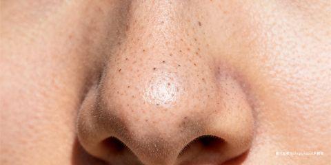 黑头粉刺（Blackheads）属于开放性粉刺，是油脂、角质与污垢堵塞毛孔后，与空气接触氧化所形成的黑点。许多人虽经常清理，却发现黑头总是「清不干净」，甚至越清越多。这往往与错误的清洁观念与护理方法有关。本文将解析黑头难以彻底清除的原因，并揭露常见误区。