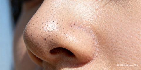 黑头粉刺（Blackheads）属于开放性粉刺，主要由皮脂分泌过多、角质堆积与毛孔氧化作用形成。许多人希望透过「自制偏方」来去黑头，认为天然、安全、又能节省成本。然而，虽然某些家庭护理方法确实有辅助清洁或舒缓效果，但并非所有 DIY 方法都科学有效，甚至有些还存在风险。本文将全面解析常见自制去黑头方法，并提供专业建议。