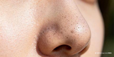 现代人生活步调紧凑，长期处于压力环境下，不仅影响心理健康，也会对皮肤造成负面影响。许多人发现，一旦压力大或睡眠不足，脸上黑头、粉刺与痘痘就会变多。这背后的关键因素之一，就是压力相关的荷尔蒙变化。本文将解析压力如何透过荷尔蒙影响皮肤，进而加重黑头问题。