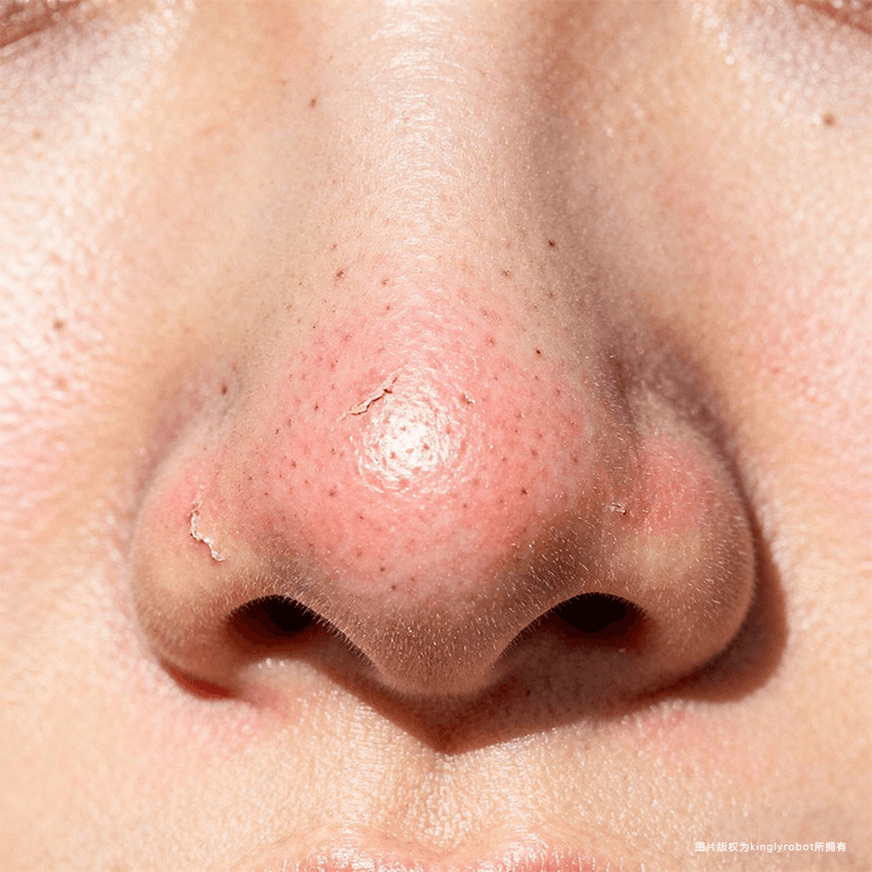 黑头贴的限制与风险