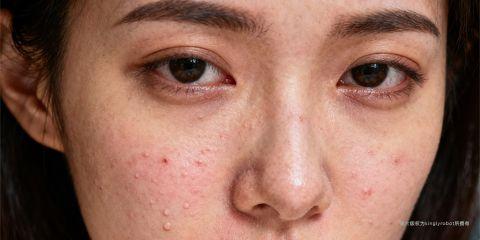 敏感肌的形成与遗传、环境及生活习惯有关,其中「饮食」是不可忽视的重要因素。某些食物可能透过引发发炎反应、释放组织胺或削弱皮肤屏障而加剧敏感症状,导致红、痒、刺痛甚至痘痘生成。了解哪些食物容易诱发敏感,能帮助敏感肌人群更好地进行日常饮食管理,降低肌肤不适。