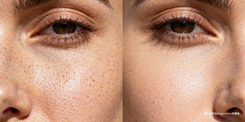 毛孔问题不仅与油脂分泌、清洁习惯有关,紫外线也是一个经常被忽视的重要因素。研究显示,长期日晒不仅会造成肤色不均与斑点,更会透过「光老化(Photoaging)」机制,使毛孔变得粗大、失去弹性,甚至伴随细纹出现。本文将深入解析紫外线如何影响毛孔健康,以及防晒在毛孔抗老中的核心地位。