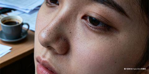 黑头粉刺是皮肤常见的瑕疵之一,虽然多数人将其归因于油脂分泌与清洁不当,但实际上,生活作息尤其是熬夜,对黑头的生成与恶化也有密切关联。从皮肤生理学到内分泌调控,熬夜带来的隐藏代价,远超过单纯的「黑眼圈」或「肤色暗沉」。