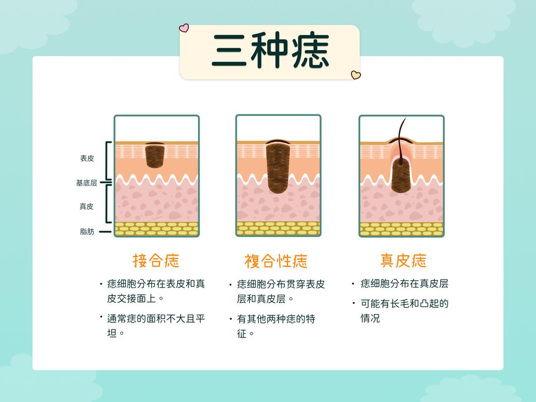 痣的种类有哪些呢?