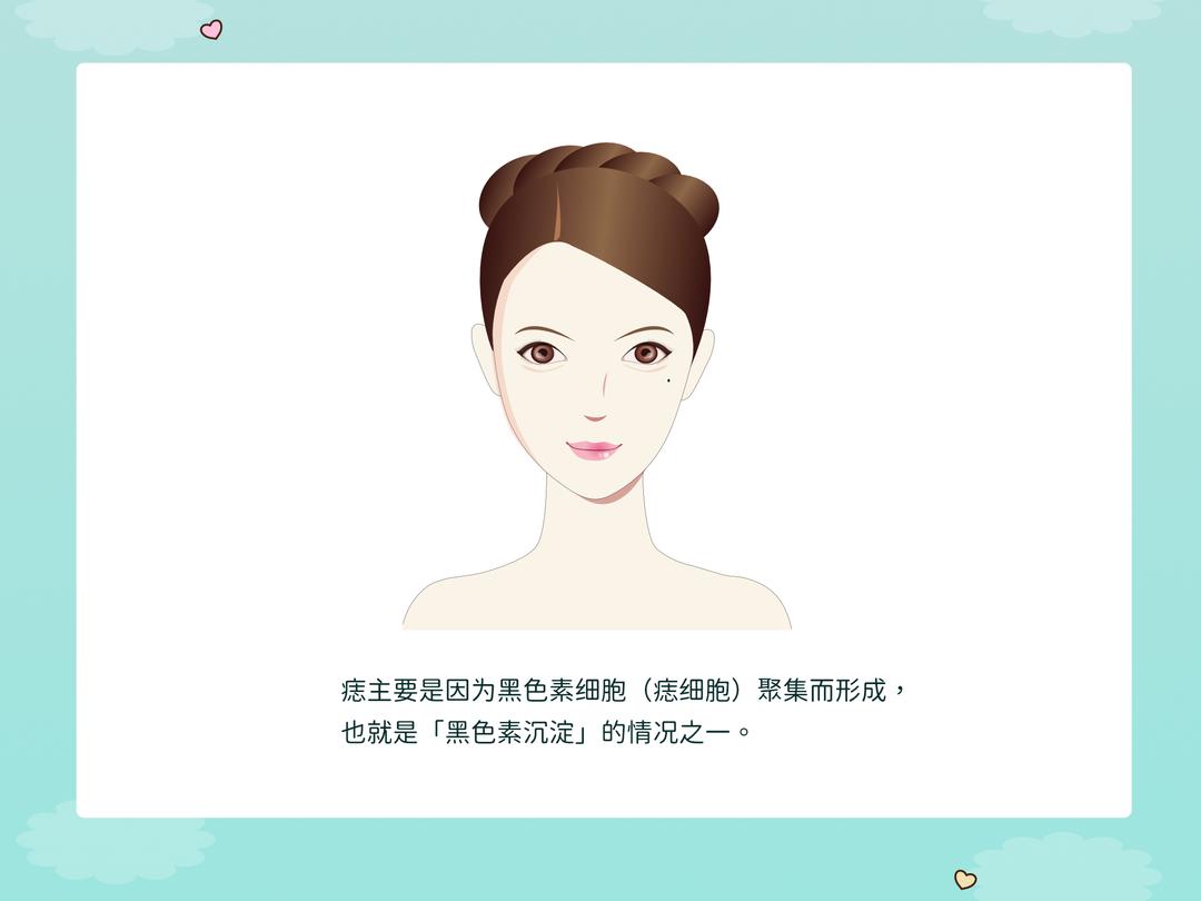 为什么会长痣?