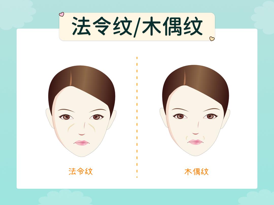 木偶纹/嘴角纹