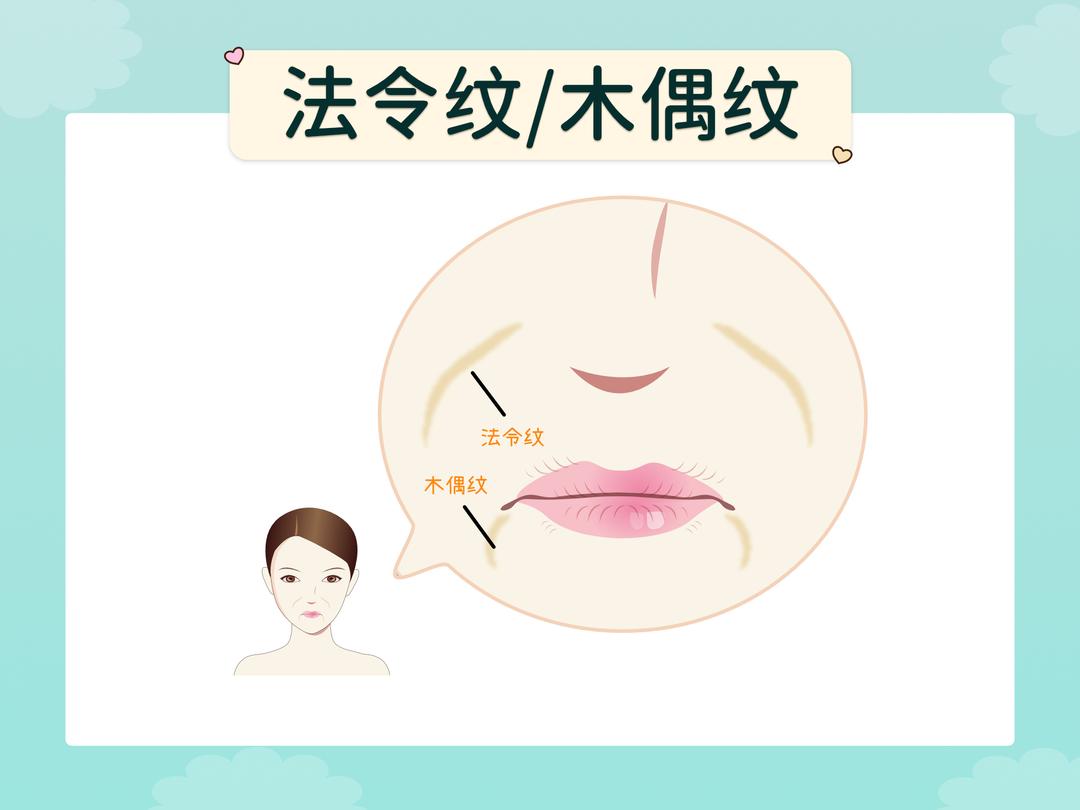 木偶纹/嘴角纹