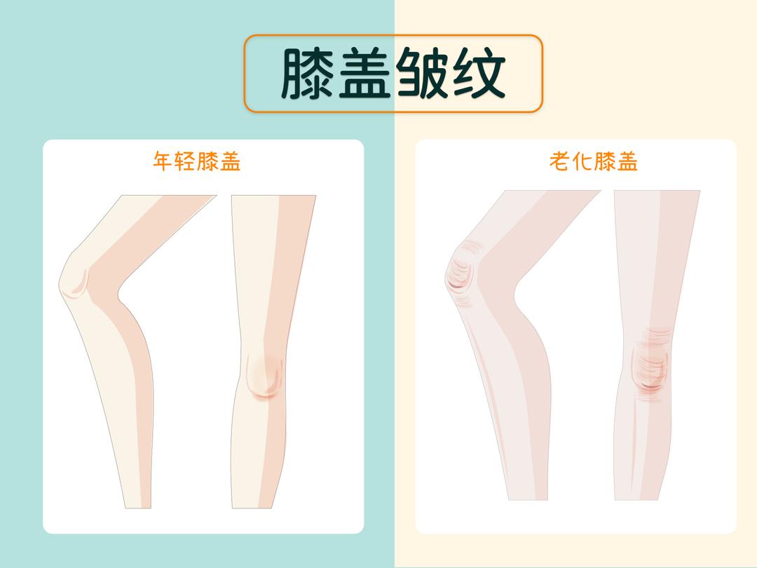 固有性皱纹(体位性皱纹)