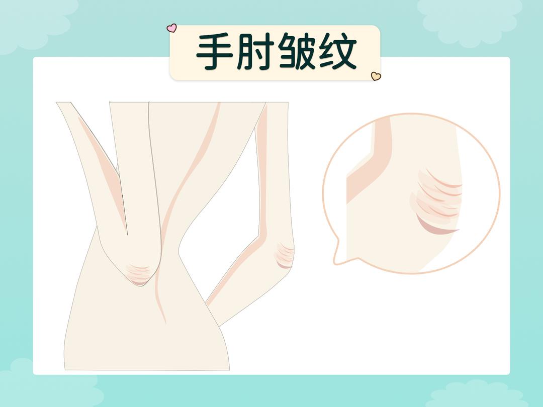 固有性皱纹(体位性皱纹)