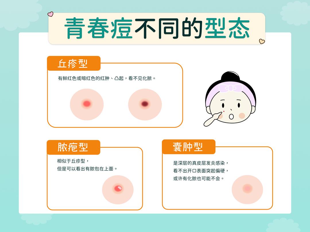 痘痘种类