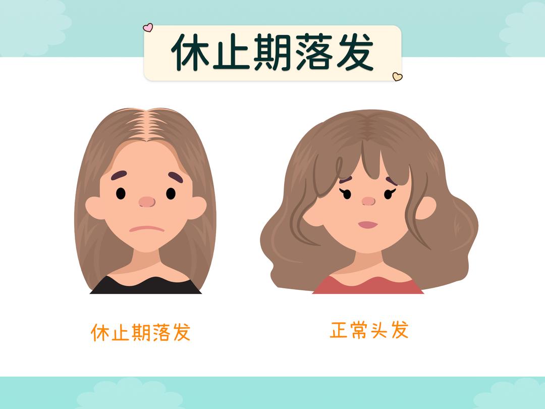 秃头的类型有哪些?