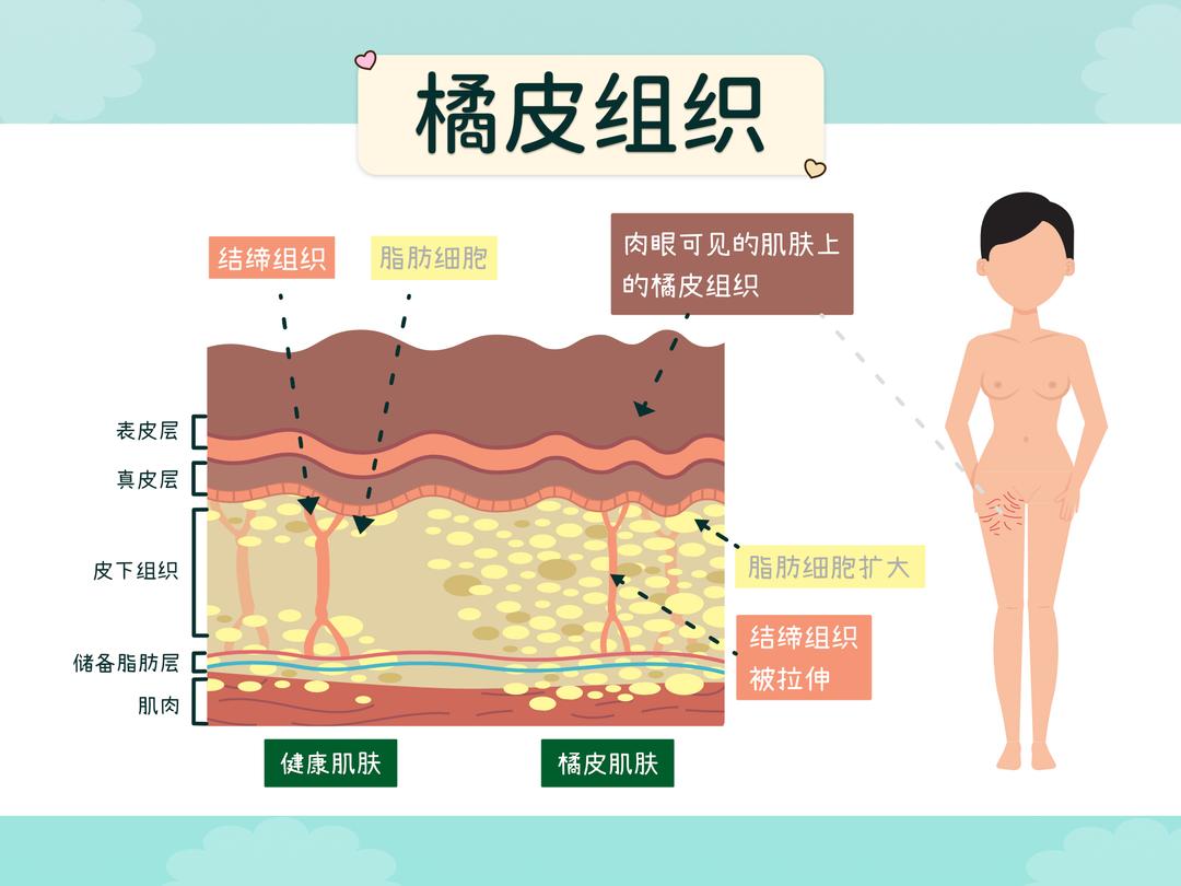 橘皮的成因有哪些?
