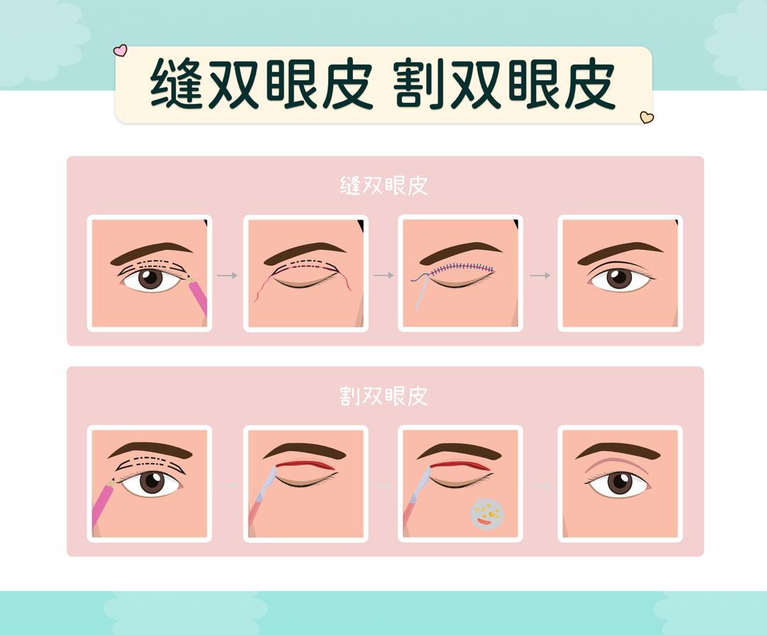 双眼皮整形手术