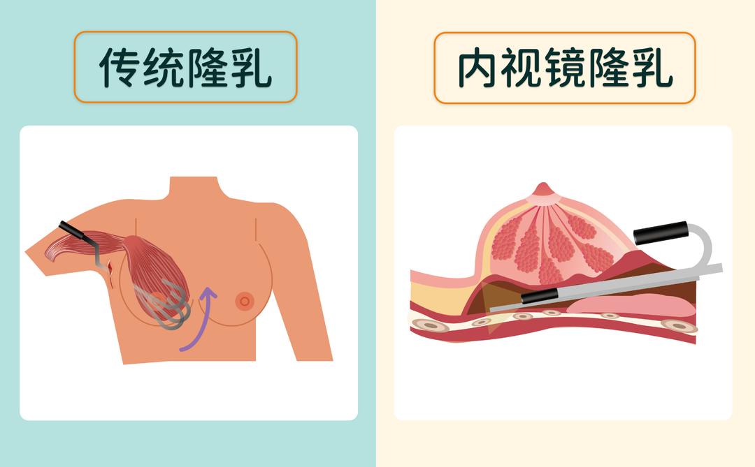 隆乳整形手术