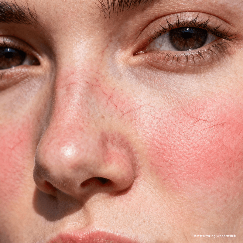 容易泛红与血管扩张