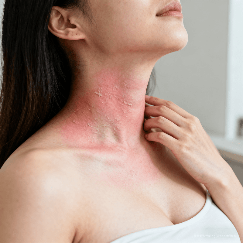 孕期与产后敏感肌的特点