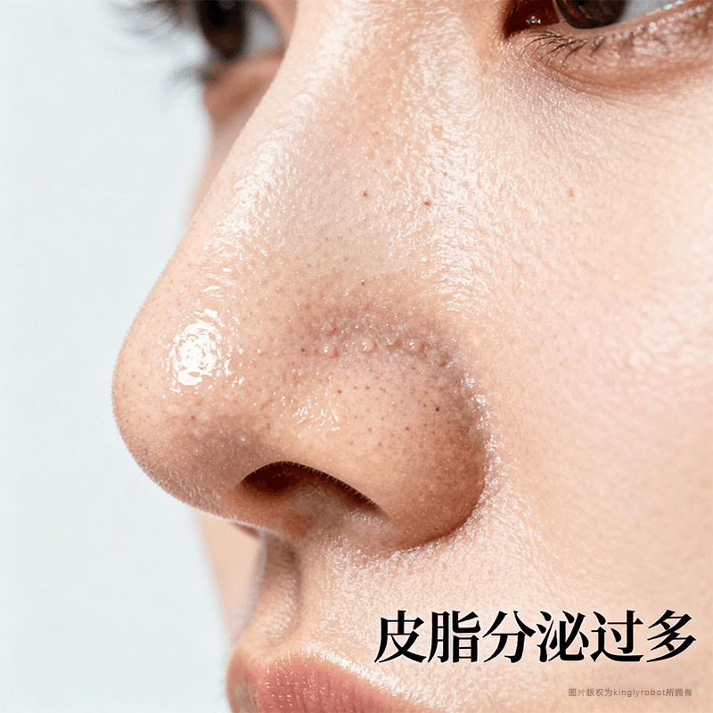 草莓鼻的主要成因