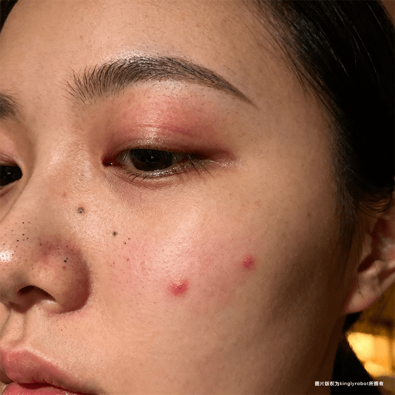 压力如何加重黑头形成